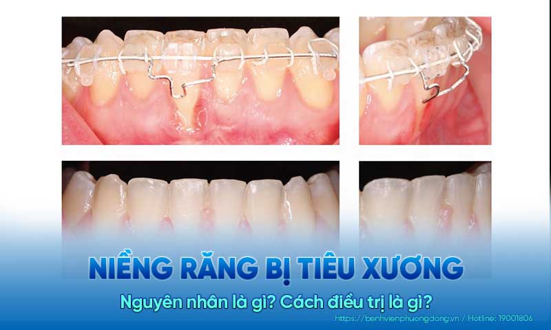 Niềng răng bị tiêu xương có nguy hiểm không? Làm thế nào để phòng tránh?