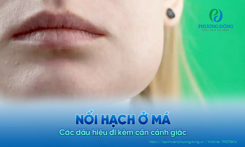 Nổi hạch ở má và các dấu hiệu đi kèm cần cảnh giác
