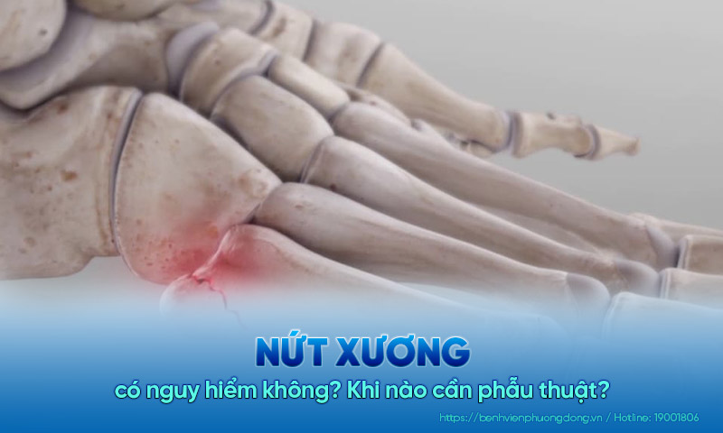 Nứt xương có nguy hiểm không? Khi nào cần phẫu thuật?