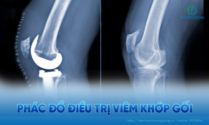 Phác đồ điều trị viêm khớp gối chuẩn hướng dẫn Bộ Y tế