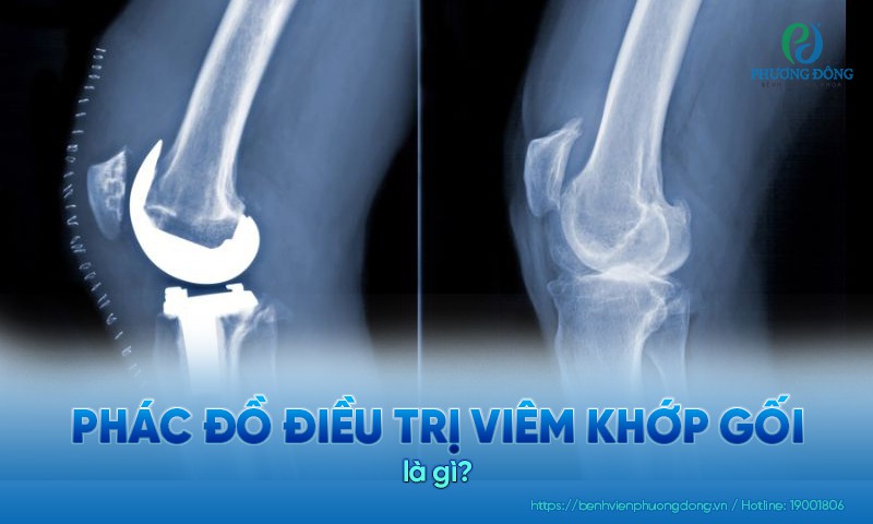 Nguyên tắc xây dựng phác đồ điều trị viêm khớp gối