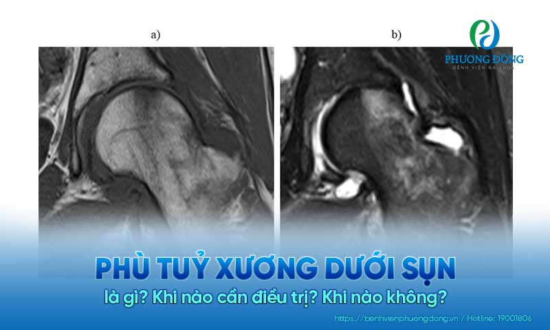 Phù tủy xương dưới sụn là gì? Khi nào cần điều trị? Khi nào không?