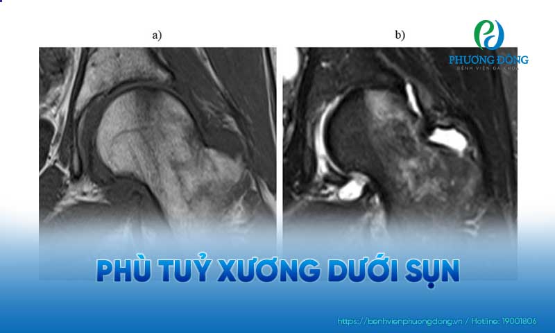 Hình chụp phù tuỷ xương trên phim MRI