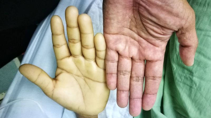 Người bị thiếu máu có nguy cơ phù tuỷ cao hơn bình thường