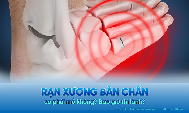 Rạn xương bàn chân có phải mổ không? Bao giờ thì lành?