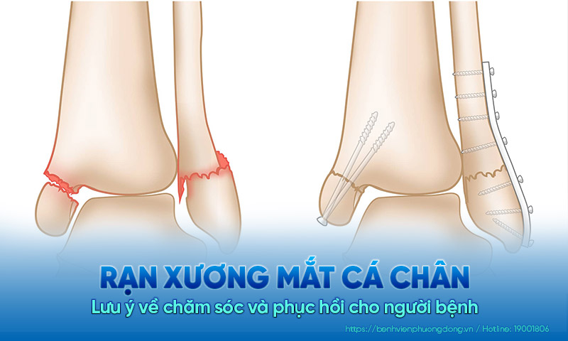 Rạn xương mắt cá chân: Lưu ý gì khi chăm sóc và phục hồi cho người bệnh?