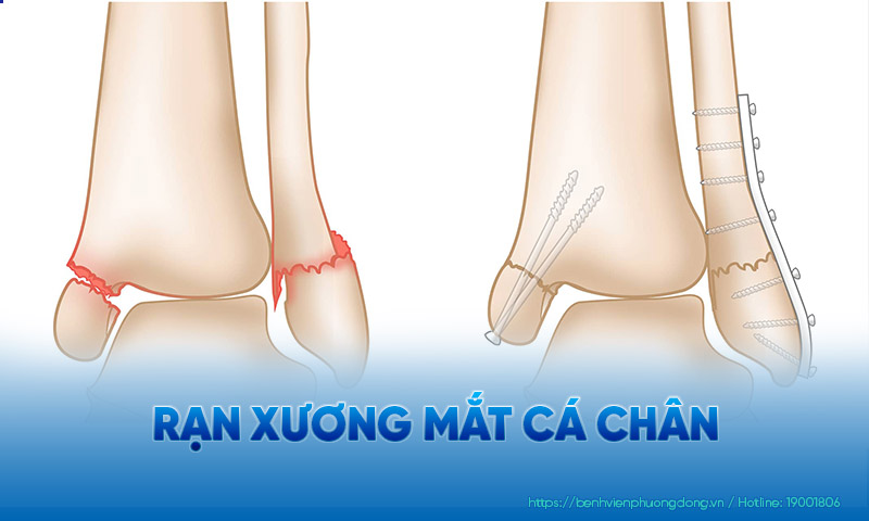 Mắt cá chân bị rạn được xếp vào dạng gãy xương kín