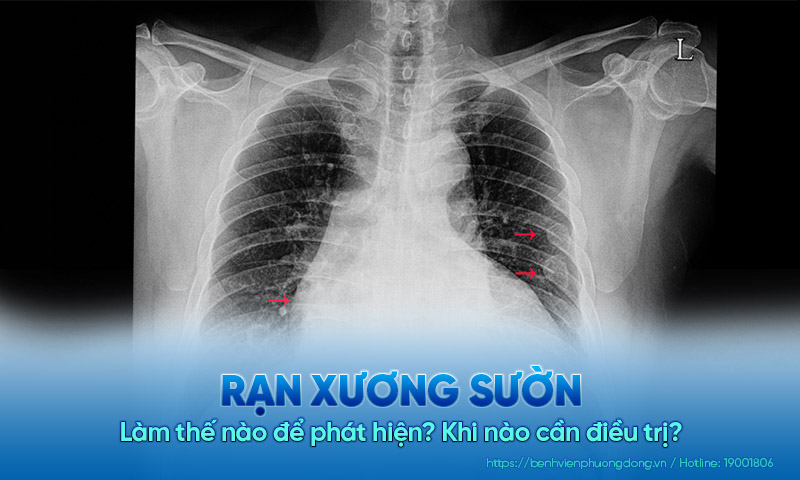 Làm thế nào để phát hiện rạn xương sườn? Khi nào cần điều trị?