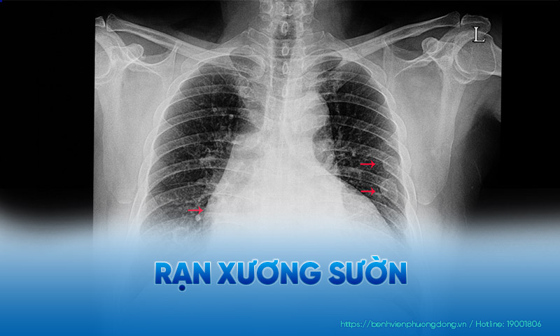 Xương sườn đóng vai trò vô cùng quan trọng trong cơ thể