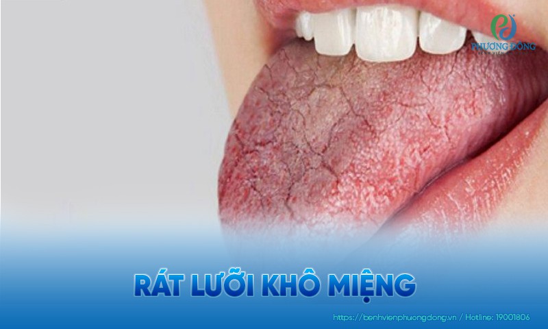 Rát lưỡi khô miệng: Triệu chứng, nguyên nhân và cách điều trị