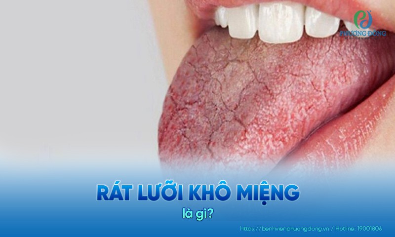 Rát lưỡi khô miệng thường là triệu chứng, không phải bệnh lý