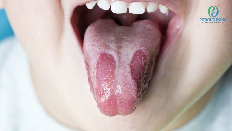 Khô miệng rát lưỡi thường đi kèm với các triệu chứng khó chịu khác