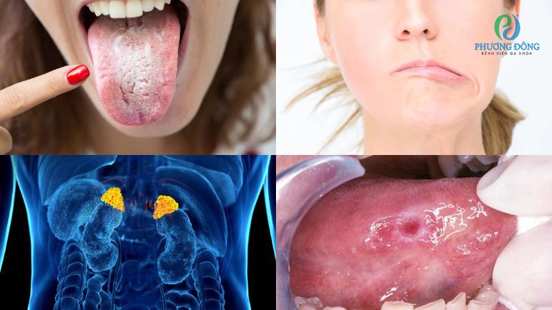 Nhóm nguyên nhân bệnh lý, chấn thương ảnh hưởng đến đường truyền dẫn vị giác