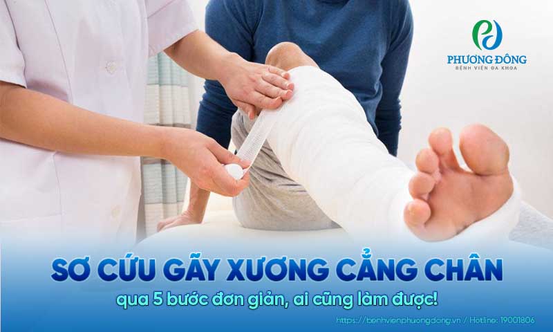 Sơ cứu gãy xương cẳng chân qua 5 bước đơn giản, ai cũng làm được! 