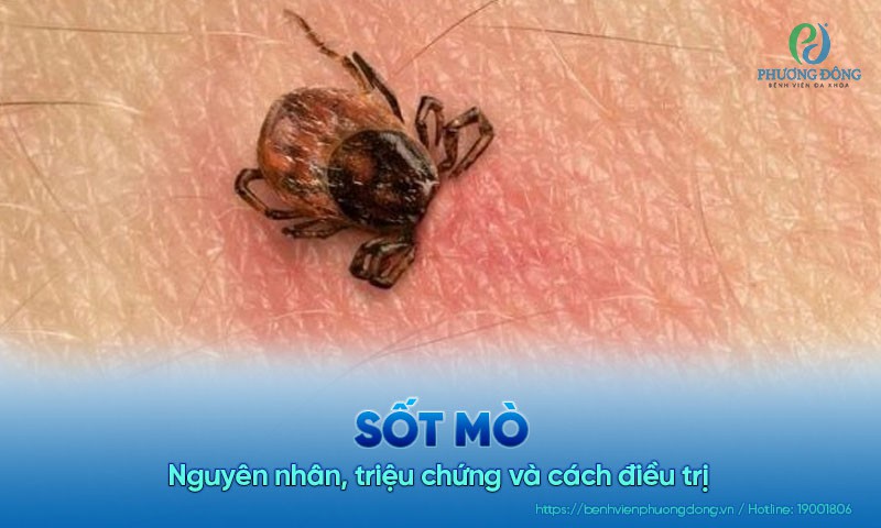 Bệnh sốt mò: Nguyên nhân, triệu chứng và cách điều trị bệnh