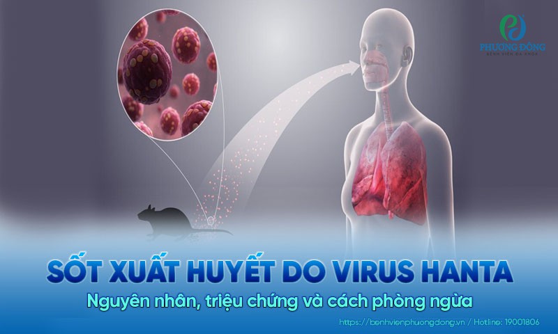 Sốt xuất huyết do virus hanta: Nguyên nhân, triệu chứng và cách phòng ngừa