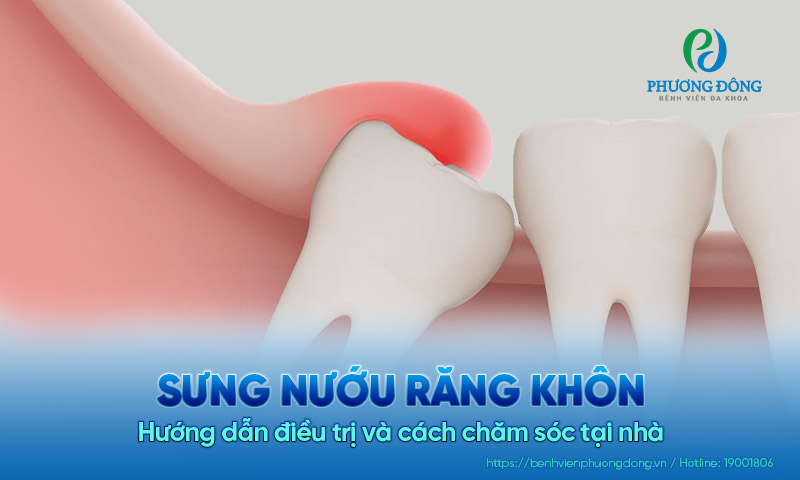 Sưng nướu răng khôn: Hướng dẫn điều trị và cách chăm sóc tại nhà