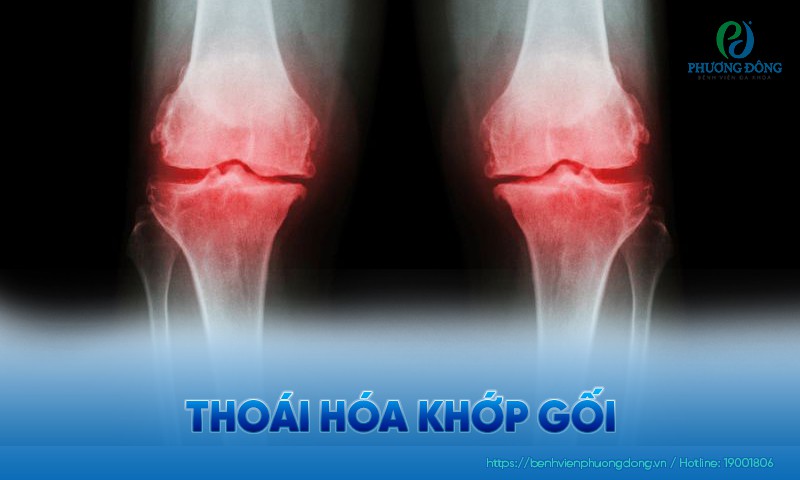 Thoái hóa khớp gối: Nguyên nhân, triệu chứng và hướng điều trị