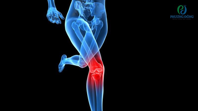 Chấn thương là nguyên nhân hàng đầu khiến khớp gối thoái hóa