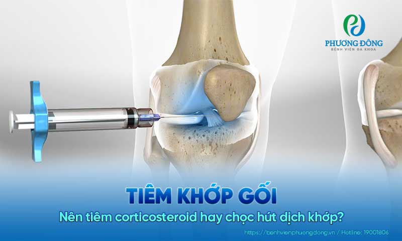 Tiêm khớp gối: Nên tiêm corticosteroid hay chọc hút dịch khớp?