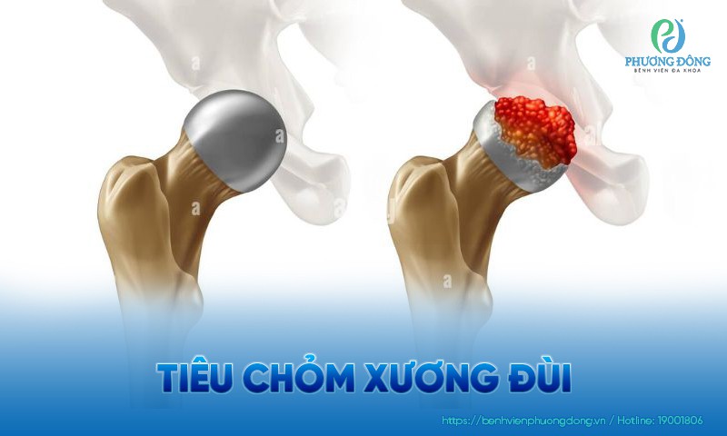 Tiêu chỏm xương đùi: Triệu chứng, nguyên nhân và điều trị