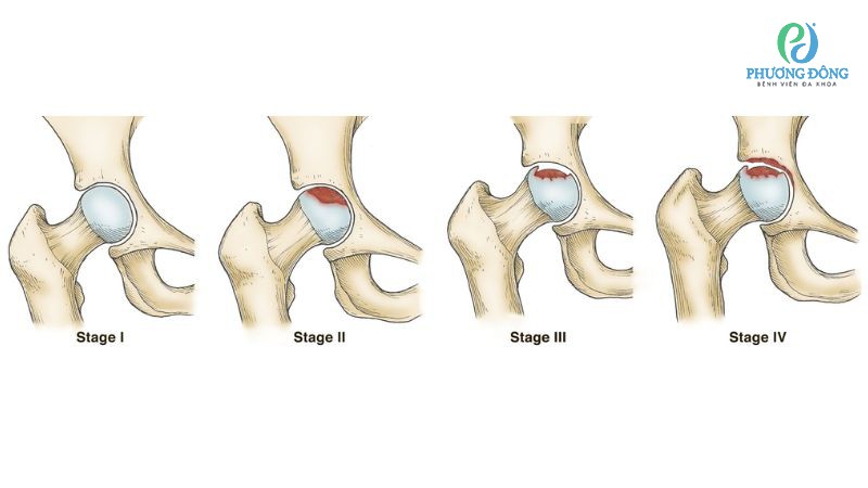 Phân loại cấp độ hoại tử vô mạch chỏm xương đùi nhằm tối ưu hiệu quả điều trị