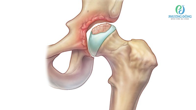 Nhóm nguyên nhân chính gây hoại tử chỏm xương đùi