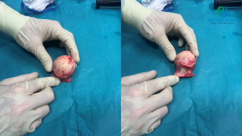 Biện pháp phòng ngừa, bảo vệ chỏm xương đùi