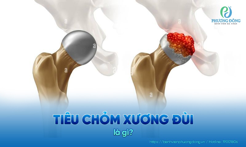 Tiêu chỏm xương đùi xảy ra do tình trạng thiếu máu nuôi dưỡng