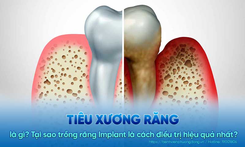 Tiêu xương răng là gì? Tại sao trồng răng Implant là cách điều trị hiệu quả nhất?