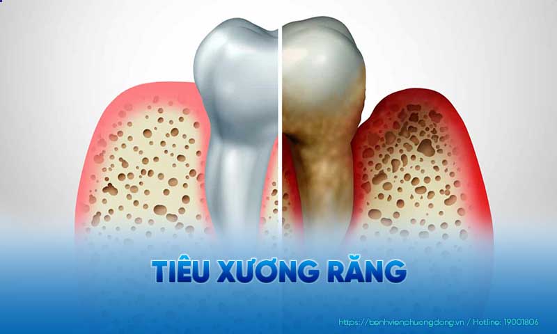 Minh hoạ hình ảnh chân răng đang bị tiêu dần xương