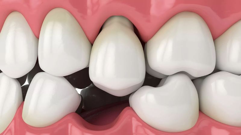 Tiêu xương có thể làm cho răng lung lay dần