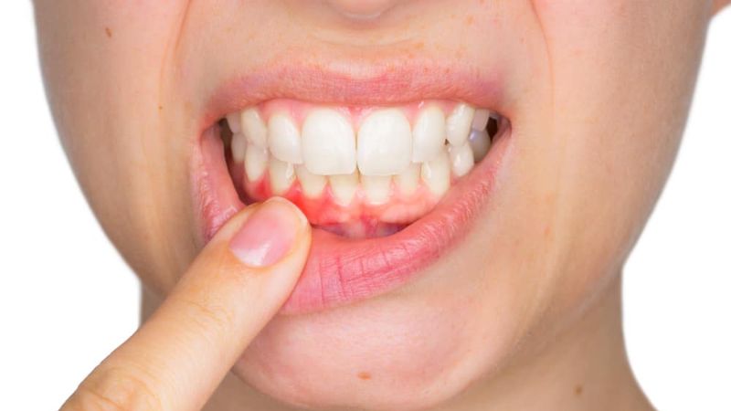Nướu sưng đỏ là một trong các dấu hiệu của tiêu xương