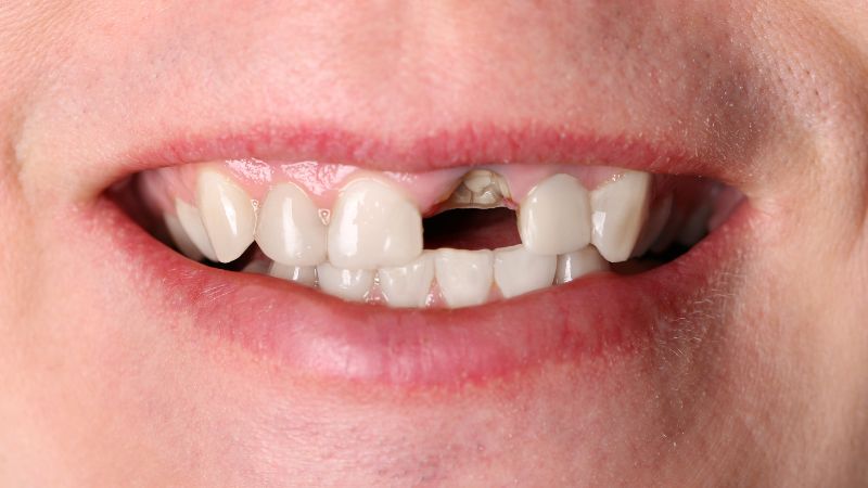 Mất răng có thể là điểm trừ về ngoại hình cho người bệnh