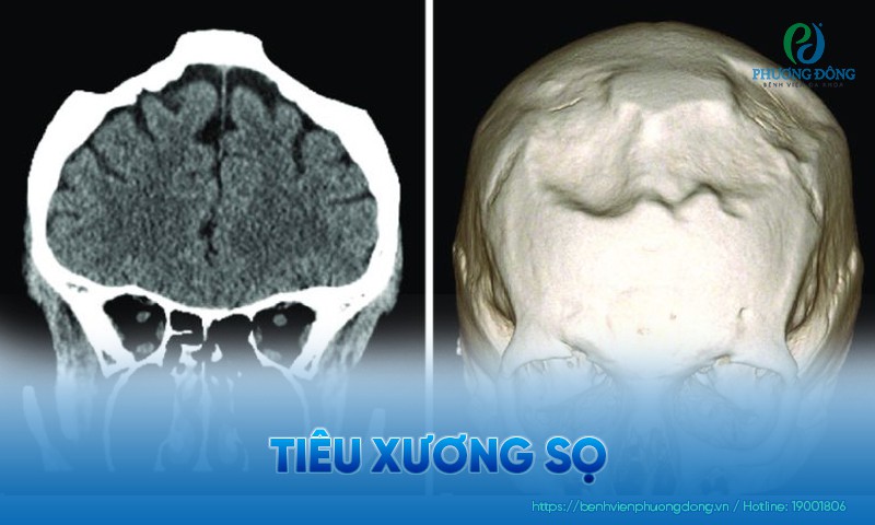 Tiêu xương sọ: Triệu chứng, nguyên nhân và hướng điều trị