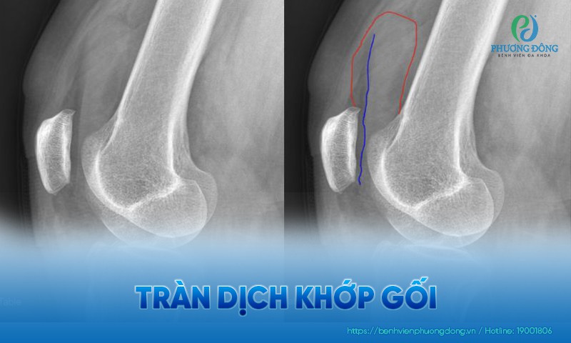 Tràn dịch khớp gối: Dấu hiệu, nguyên nhân và hướng điều trị