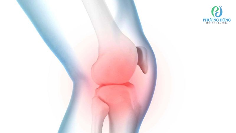 Triệu chứng lâm sàng khi đầu gối bị tràn dịch