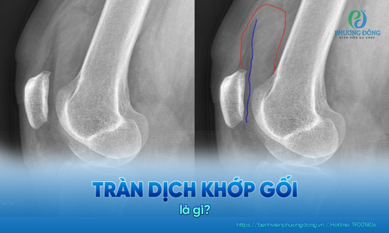Hình ảnh xét nghiệm tràn dịch khớp gối