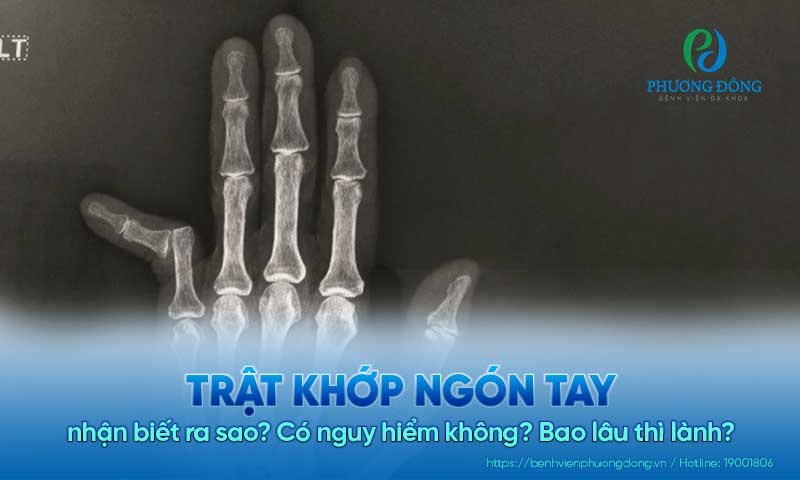 Trật khớp ngón tay nhận biết ra sao? Có nguy hiểm không? Bao lâu thì lành?