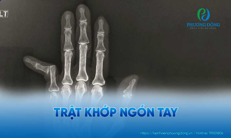 Hình ảnh trật khớp dưới phim chụp X Quang