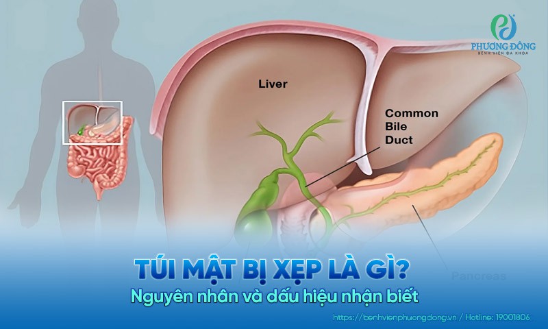 Túi mật bị xẹp là gì? Nguyên nhân và dấu hiệu nhận biết