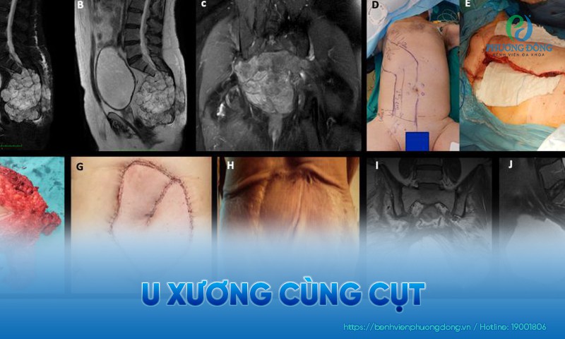 U xương cùng cụt: Triệu chứng, nguyên nhân và hướng điều trị
