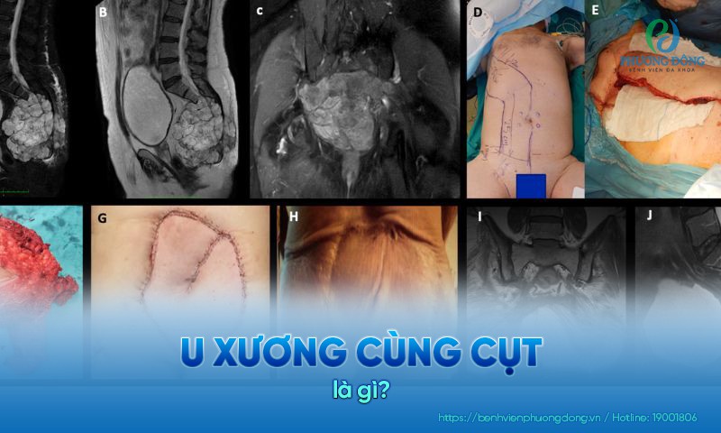 U xương cùng cụt là một khối u bẩm sinh lành tính ở thai nhi và trẻ sơ sinh
