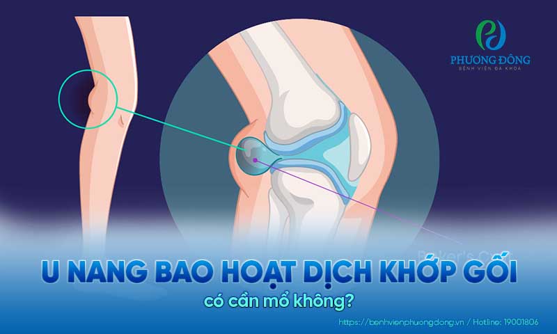 U nang bao hoạt dịch khớp gối có cần mổ không? Khi nào cần điều trị?