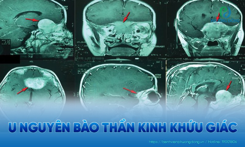 U nguyên bào thần kinh khứu giác: Nguyên nhân, triệu chứng và điều trị