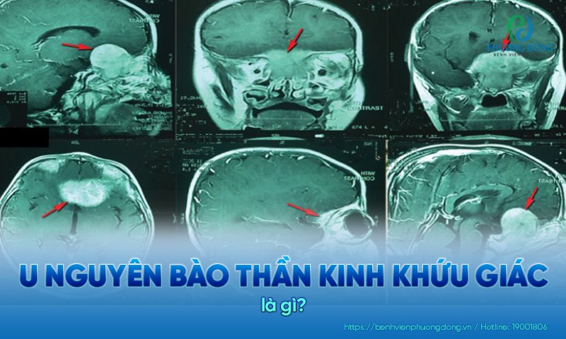 Hình ảnh u nguyên bào thần kinh khứu giác