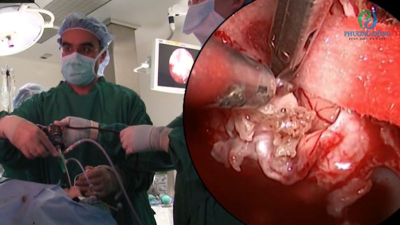 Điều trị phẫu thuật là phương pháp được áp dụng chính