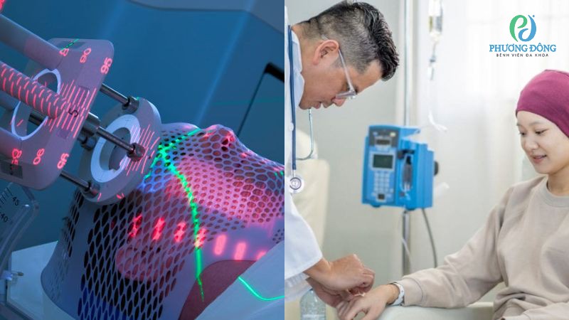Hoá trị, xạ trị là hướng can thiệp hỗ trợ, loại bỏ tế bào ung thư còn sót lại