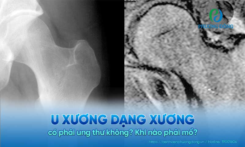 U xương dạng xương có phải ung thư không? Khi nào phải mổ?