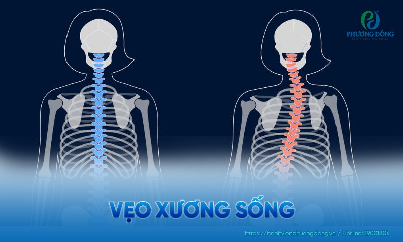 Vẹo xương sống: Nguyên nhân, triệu chứng và hướng điều trị